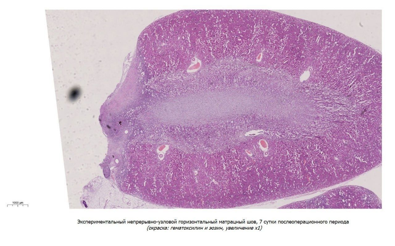 Белгородские ученые изобрели хирургический шов, снижающий риск осложнений